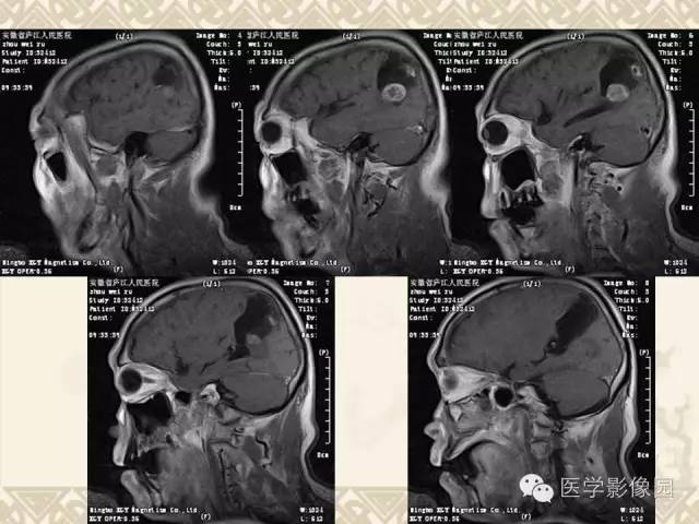 【病例】成人血管母1例CT及MR影像表现