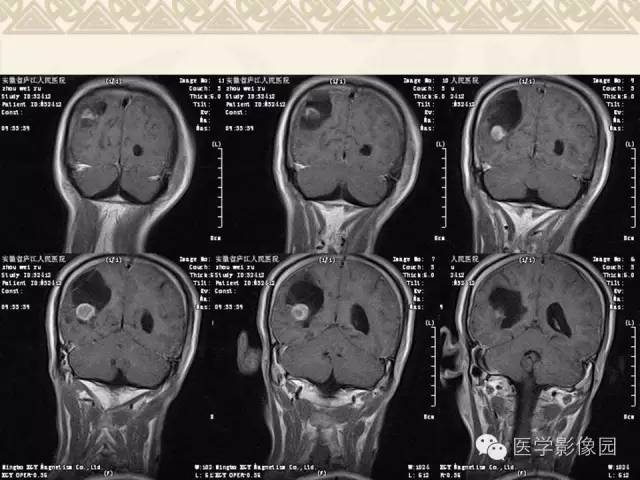 【病例】成人血管母1例CT及MR影像表现