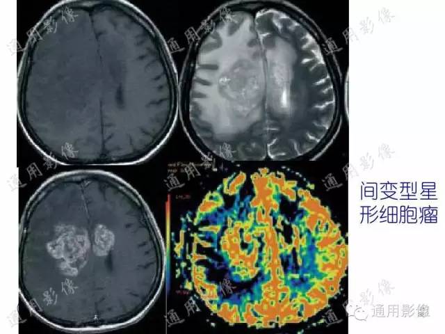 【PPT】PWI原理及临床应用