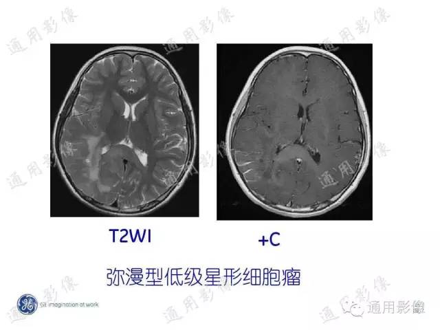 【PPT】PWI原理及临床应用