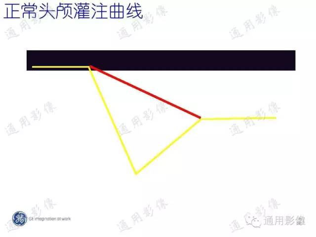 【PPT】PWI原理及临床应用