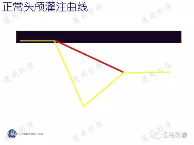【PPT】PWI原理及临床应用