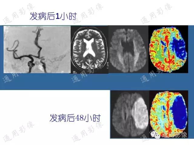 【PPT】PWI原理及临床应用