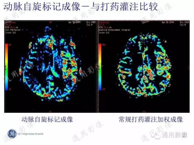 【PPT】PWI原理及临床应用