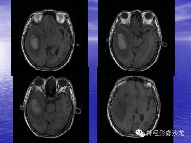 【病例】脑胶质母细胞瘤伴肿瘤卒中一例CT及MR影像表现