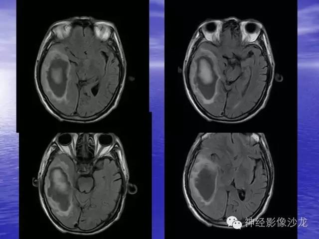 【病例】脑胶质母细胞瘤伴肿瘤卒中一例CT及MR影像表现