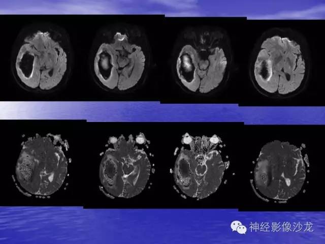 【病例】脑胶质母细胞瘤伴肿瘤卒中一例CT及MR影像表现