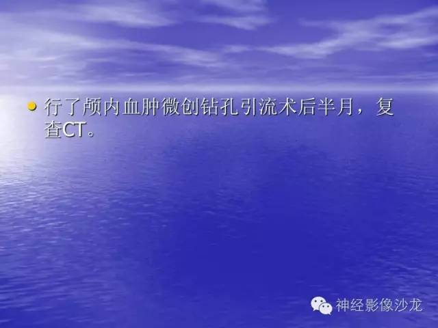 【病例】脑胶质母细胞瘤伴肿瘤卒中一例CT及MR影像表现