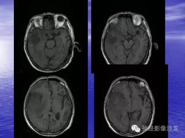 【病例】脑胶质母细胞瘤伴肿瘤卒中一例CT及MR影像表现