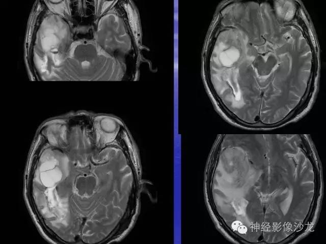 【病例】脑胶质母细胞瘤伴肿瘤卒中一例CT及MR影像表现