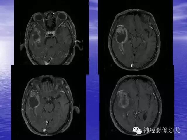 【病例】脑胶质母细胞瘤伴肿瘤卒中一例CT及MR影像表现