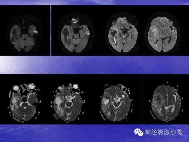 【病例】脑胶质母细胞瘤伴肿瘤卒中一例CT及MR影像表现