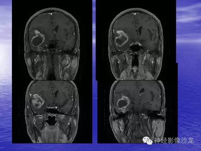 【病例】脑胶质母细胞瘤伴肿瘤卒中一例CT及MR影像表现