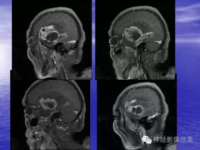 【病例】脑胶质母细胞瘤伴肿瘤卒中一例CT及MR影像表现
