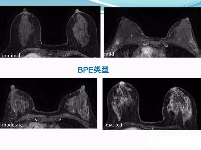 【PPT】新版乳腺MR BI-RADS术语及分类的解读