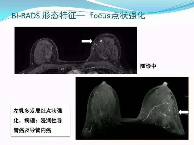 【PPT】新版乳腺MR BI-RADS术语及分类的解读