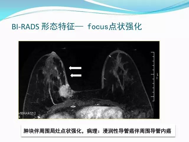 【PPT】新版乳腺MR BI-RADS术语及分类的解读