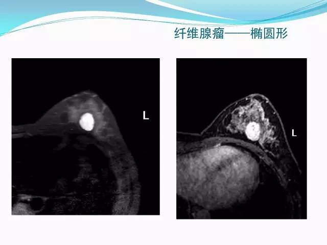 【PPT】新版乳腺MR BI-RADS术语及分类的解读