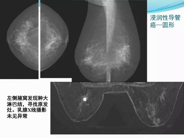 【PPT】新版乳腺MR BI-RADS术语及分类的解读