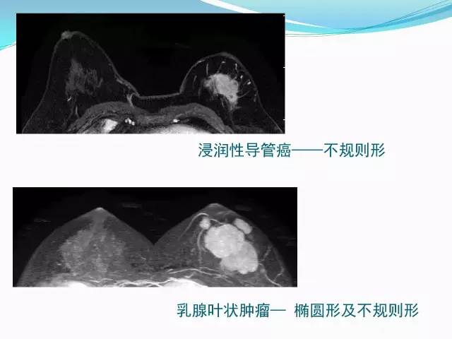 【PPT】新版乳腺MR BI-RADS术语及分类的解读