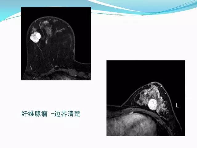 【PPT】新版乳腺MR BI-RADS术语及分类的解读