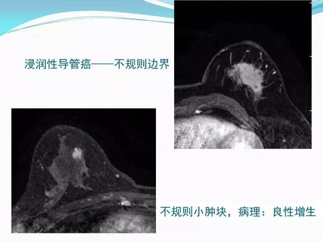 【PPT】新版乳腺MR BI-RADS术语及分类的解读