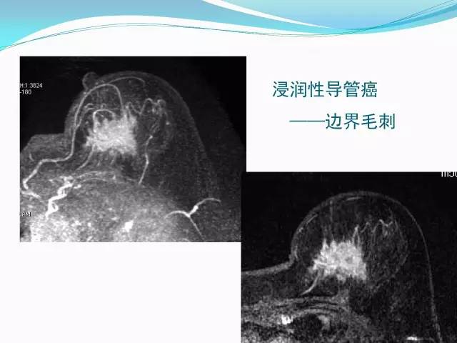 【PPT】新版乳腺MR BI-RADS术语及分类的解读