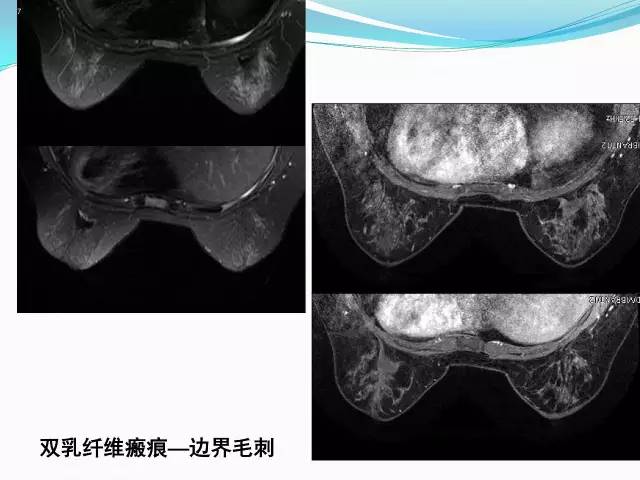 【PPT】新版乳腺MR BI-RADS术语及分类的解读