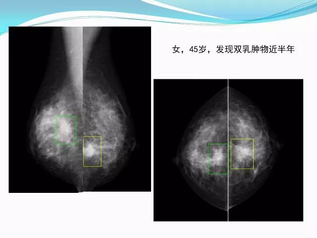 【PPT】新版乳腺MR BI-RADS术语及分类的解读