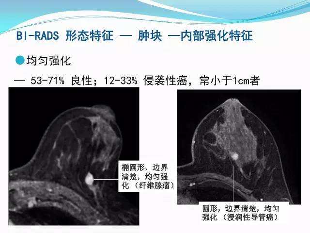 【PPT】新版乳腺MR BI-RADS术语及分类的解读