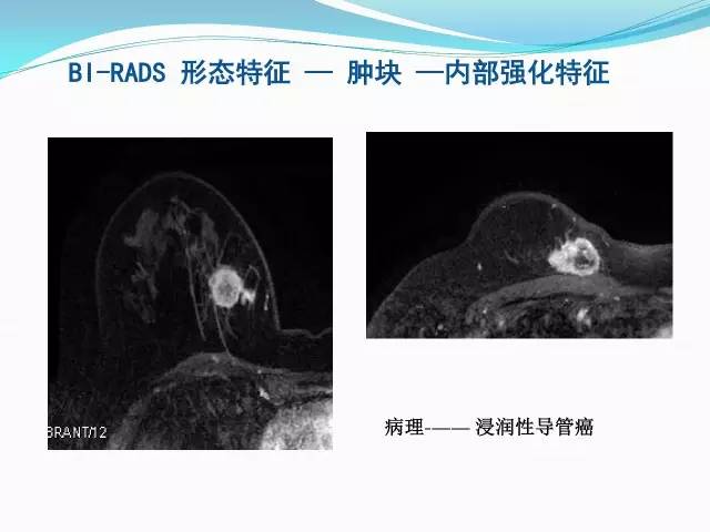【PPT】新版乳腺MR BI-RADS术语及分类的解读