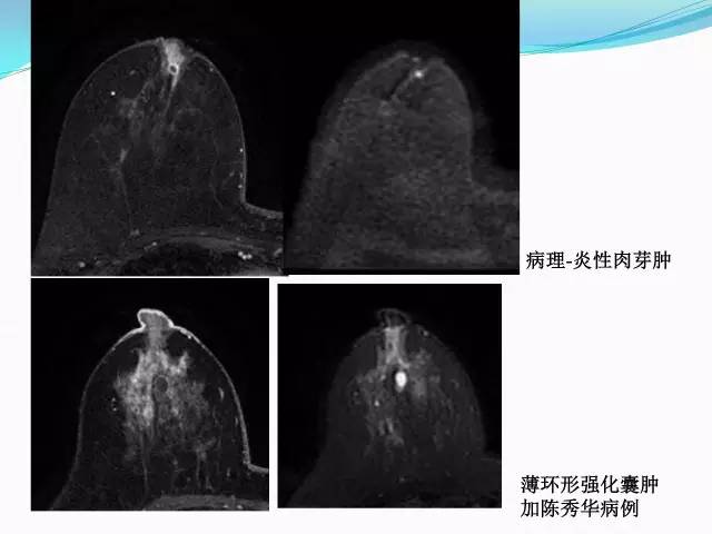 【PPT】新版乳腺MR BI-RADS术语及分类的解读