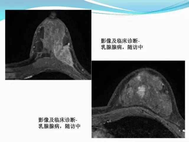 【PPT】新版乳腺MR BI-RADS术语及分类的解读