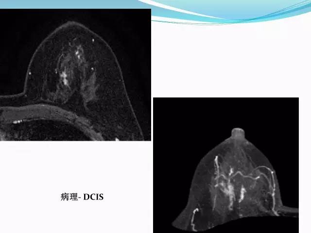 【PPT】新版乳腺MR BI-RADS术语及分类的解读