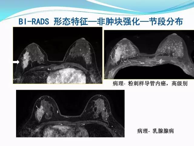 【PPT】新版乳腺MR BI-RADS术语及分类的解读