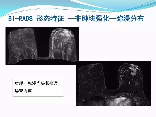 【PPT】新版乳腺MR BI-RADS术语及分类的解读