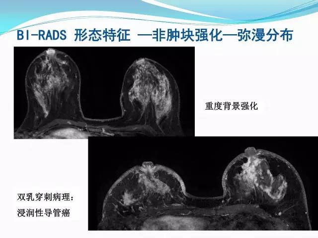 【PPT】新版乳腺MR BI-RADS术语及分类的解读