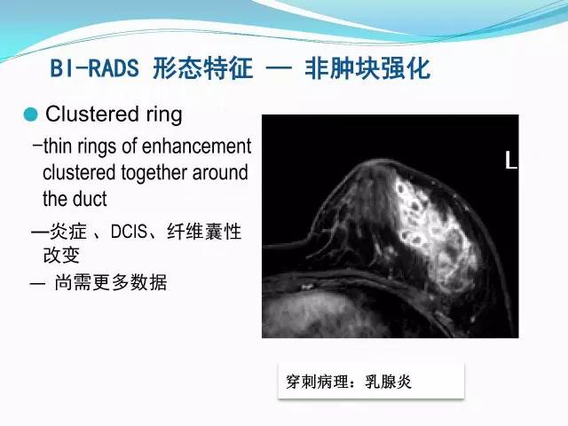 【PPT】新版乳腺MR BI-RADS术语及分类的解读