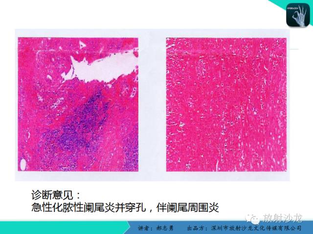 【PPT】阑尾炎穿孔