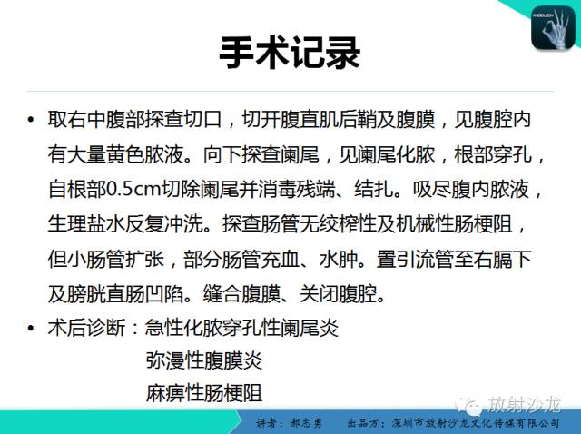 【PPT】阑尾炎穿孔