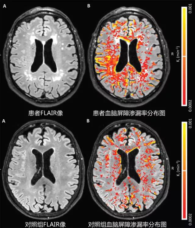 血脑屏障破坏可能是阿尔茨海默病早期的关键机制