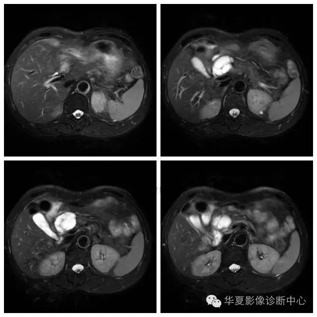【病例】胰腺神经鞘瘤1例MR影像表现 【病例】胰腺神经鞘瘤1例MR影像表现