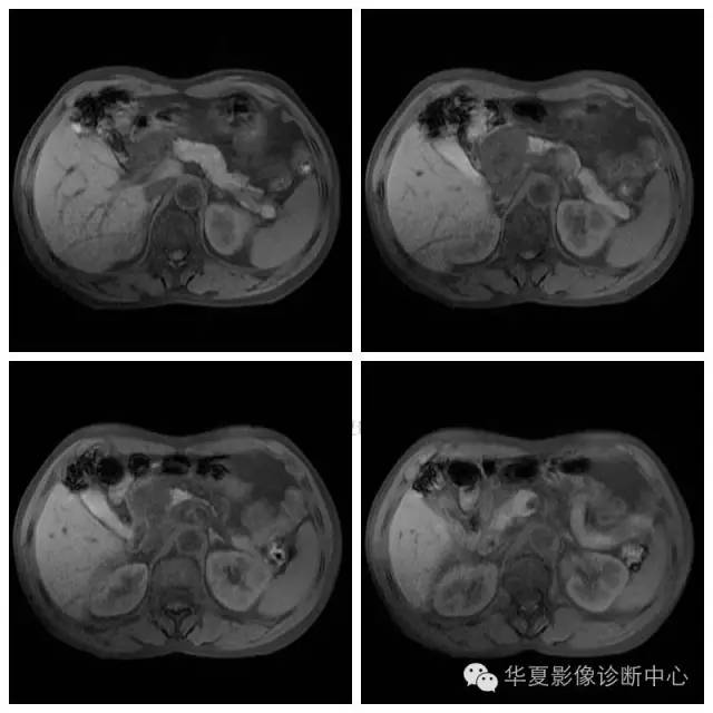 【病例】胰腺神经鞘瘤1例MR影像表现