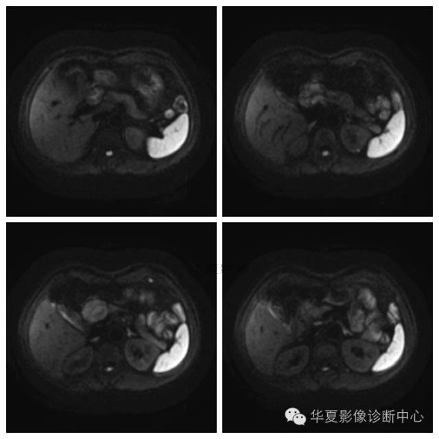 【病例】胰腺神经鞘瘤1例MR影像表现 【病例】胰腺神经鞘瘤1例MR影像表现