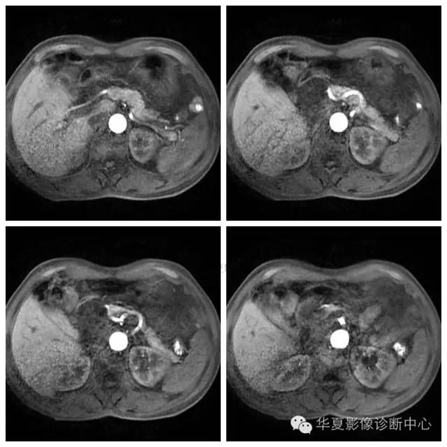 【病例】胰腺神经鞘瘤1例MR影像表现 【病例】胰腺神经鞘瘤1例MR影像表现