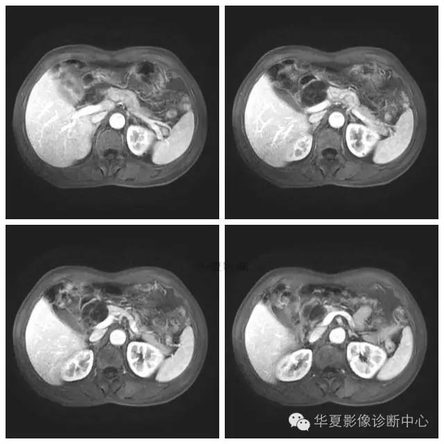 【病例】胰腺神经鞘瘤1例MR影像表现 【病例】胰腺神经鞘瘤1例MR影像表现