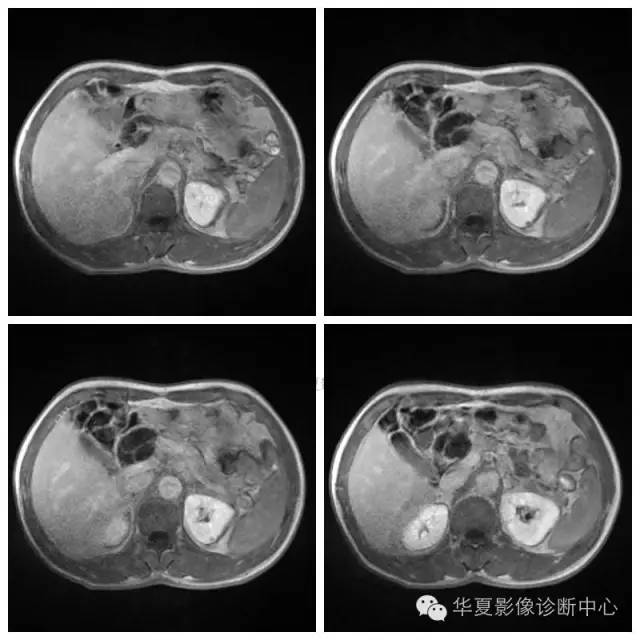【病例】胰腺神经鞘瘤1例MR影像表现 【病例】胰腺神经鞘瘤1例MR影像表现