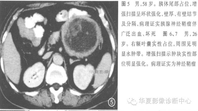 【病例】胰腺神经鞘瘤1例MR影像表现 【病例】胰腺神经鞘瘤1例MR影像表现