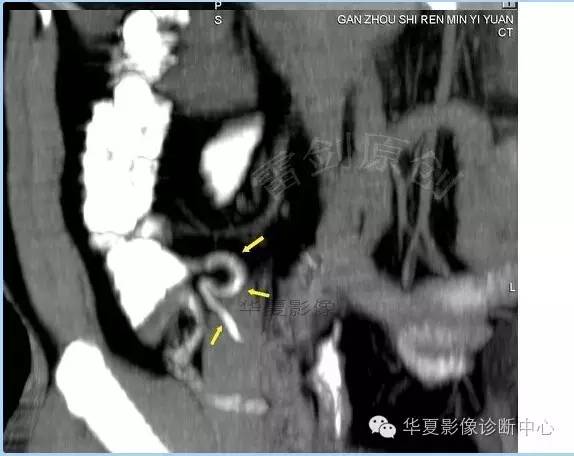 教你如何快捷、准确的找到阑尾并分析病变