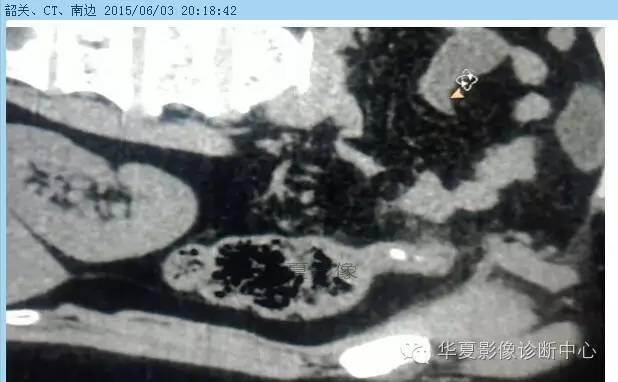 教你如何快捷、准确的找到阑尾并分析病变